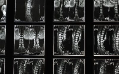 Open vs. Closed Spine MRI